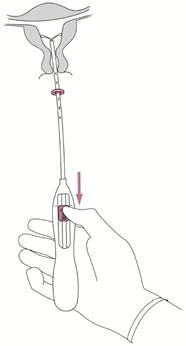 Ręka trzyma urządzenie medyczne ze strzałką skierowaną w dół, wprowadzając je do schematu anatomicznego żeńskich narządów płciowych w celu wykonania procedury