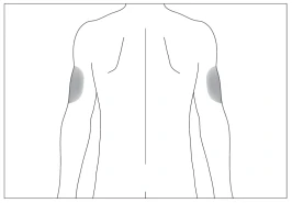 Schematic illustration of the human body with highlighted areas of the shoulder muscles