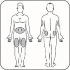 Human body diagram with marked zones for injection
