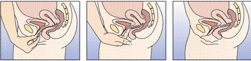 Schematic illustration of three stages of administering a drug into the uterus through the vagina using a specialized drug delivery device