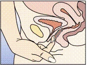 A woman's hand inserting a syringe into the vaginal cavity, showing anatomical structures: uterus, ovaries, and vagina, with visualization of the injection site