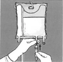Hands connecting a syringe to an infusion system by inserting it into the port of a solution bag for intravenous administration