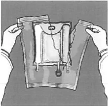 Two hands holding a medical device with internal tubing and connecting elements intended for infusion or drainage