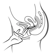 Mano che impugna una siringa, inserendo l'ago nel tessuto muscolare della coscia con un angolo, con anatomia del bacino e dei muscoli visibile