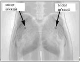 Radiografia del torace con marcature dei siti di iniezione nella parte superiore dei muscoli delle spalle su entrambi i lati del corpo
